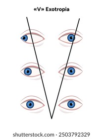 Types of strabismus, v esotropia and v exotropia	