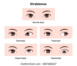 Types of strabismus vector illustration