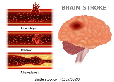 Tipos de trazo: Atherosclerosis, isquémica, hemorrágica