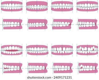 Types of tooth alignment and malocclusion. Front and side vector illustration