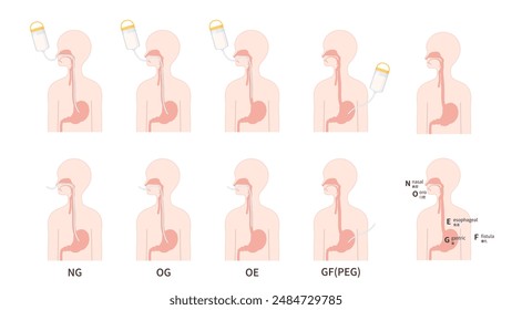 Arten der Sondenernährung und Abbildungen_Gastrostomy_NG_OG_OE