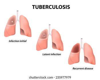 Types of Tuberculosis. Latent Tuberculosis, infection initial, recurrent disease.