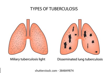 Types of tuberculosis. Miliary and disseminated pulmonary tuberculosis. Infographics. Vector illustration on isolated background.