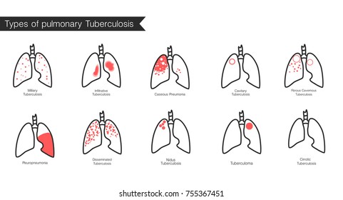 Types of tuberculosis. Vector silhouette medical illustration of human body organ - lungs with trachea. Poster for clinic, hospital. Respiratory system