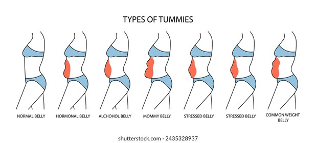 Types of tummies doodle set. Medical infographics and educational materials. Hormonal, stressed, common and mother belly. Simple flat vector illustration isolated on white background