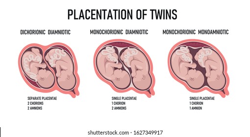 Types of Twins: Dizygotic, Monozygotic