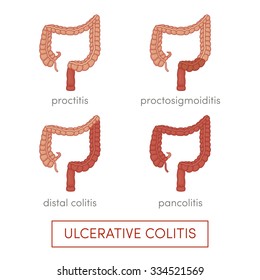Tipos de colitis ulcerosa. Dibujo vectorial de caricaturas para atlas médicos o libros de texto educativos.
