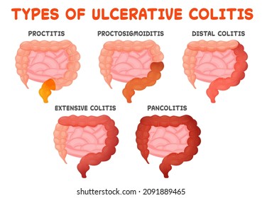 Tipos de colitis ulcerosa, enfermedad intestinal. Variantes de Cs, desde la proctitis que involucra recto hasta pancolitis con Inflamación de colon entero. Ilustración vectorial médica para el prospecto de atención médica.