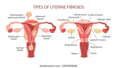 Tipos de fibromas uterinos en mujeres. Fibromas. Enfermedades del sistema reproductivo femenino. Útero sano e insalubre. Ginecología. Concepto médico. Cartel de infografía. Vector