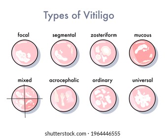 Types of vitiligo infographic icons. Options for the spread and manifestation of the skin disease.Pigmentation problem.Patchy loss of derma color.   Vector in flat style. Psoriasis. Medical banner