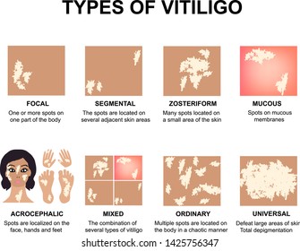 Types of vitiligo. World Vitiligo Day. Infographics. Vector illustration on isolated background.