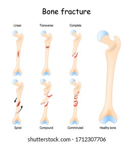 Typical bone fractures: Linear, Transverse, Complete, Compound, Spiral, and Comminuted. Healthy femur and leg fracture in different stages. Vector diagram for medical use