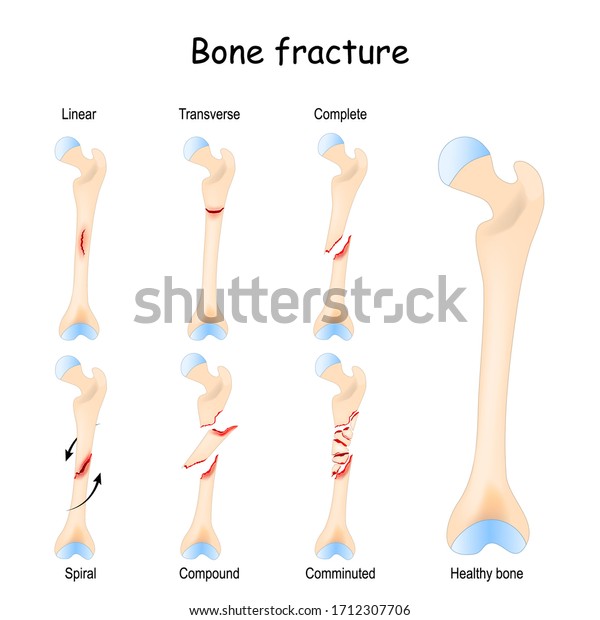 Typical Bone Fractures Linear Transverse Complete Stock Vector (Royalty ...