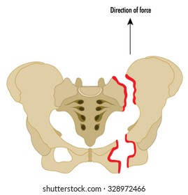 16 Sacrospinous ligament Images, Stock Photos & Vectors | Shutterstock