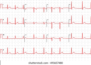 Typical human electrocardiogram, red graph with marks on white