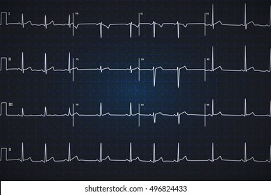 Typical human electrocardiogram, white graph on dark blue background with marks