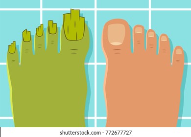 Ugly toes with a fungus. Vector cartoon illustration of a healthy and diseased foot isolated on background.