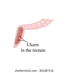 An ulcer in the rectum. Ulcers in the intestines. Vector illustration on isolation background.