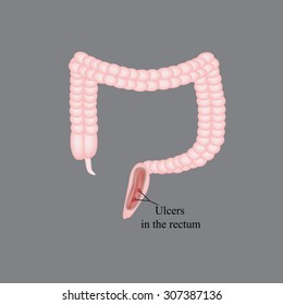 An ulcer in the rectum. Ulcers in the intestines. Vector illustration on a gray background.