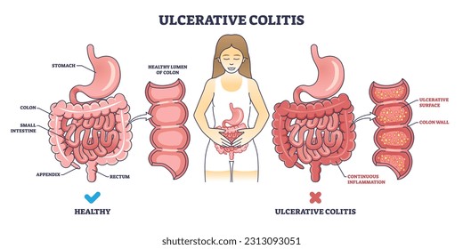 Ulcerative colitis as chronic inflammatory bowel disease outline diagram. Labeled educational scheme with medical illness of digestive system vector illustration. Ulcers inflammation description.