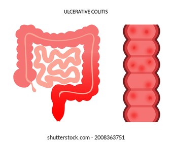 Ulcerative colitis concept. Inflammatory bowel disease. Ulcer and inflammation of the digestive tract, abdominal pain, colon problem in human body. Intestine anatomical poster flat vector illustration