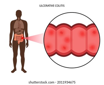 Ulcerative colitis concept. Inflammatory bowel disease. Ulcer and inflammation of the digestive tract, abdominal pain, colon problem in human body. Intestine anatomical poster flat vector illustration