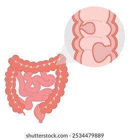 Colitis ulcerosa	Diagrama del problema gastroenterológico