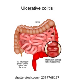 Ulcerative colitis.  inflammatory bowel disease IBD. Realistic Large and small intestine with the inflammatory process that spreads upward from the rectum. Close-up of a Inflammation