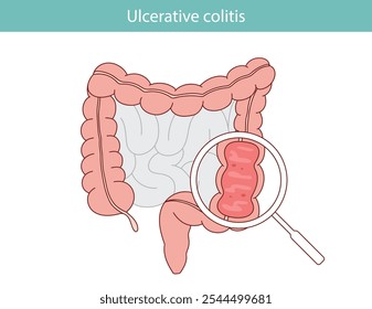 Ulcerative colitis as a schematic diagram of chronic inflammatory bowel disease. Anatomical vector illustration of diseases of the digestive system.