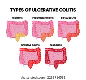 Tipos de colitis ulcerosa infografía incluyendo proctitis colitis distal pancolitis proctosigmoiditis colitis subtotal realista. Órgano interno humano, anatomía, concepto de medicina, salud.