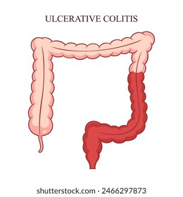 Ulcerative Colitis Vector Design Illustration