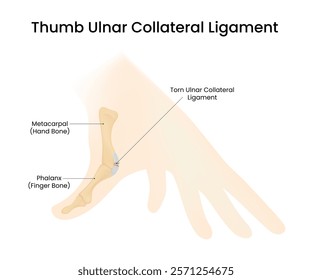 Ulnar Collateral Ligament Injury of the Thumb