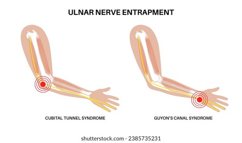 Ulnar nerve entrapment. Cubital tunnel syndrome and Guyons canal syndrome. Pressure or pulling, stretching of the ulnar nerve in the elbow and wrist regions. Pain in arm anatomical vector illustration