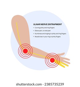 Ulnar nerve entrapment. Cubital tunnel syndrome and Guyons canal syndrome. Pressure or pulling, stretching of the ulnar nerve in the elbow and wrist regions. Pain in arm anatomical vector illustration
