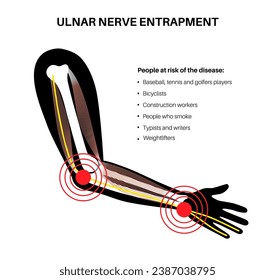 Ulnar nerve entrapment. Cubital tunnel syndrome and Guyons canal syndrome. Pressure or pulling, stretching of the ulnar nerve in the elbow and wrist regions. Pain in arm anatomical vector illustration