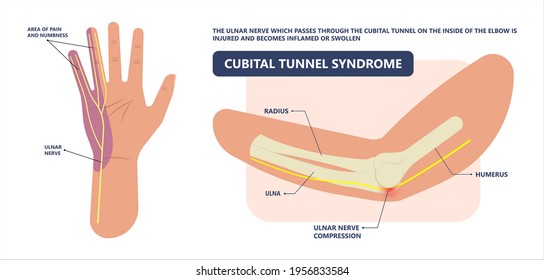 Ulnar Nerve Muscle Bone Elbow Swollen Pain Hand Palm Bone Spurs Ring Little Medial Golfer Radial Arms Wrist Funny Carpal Tennis Canal Palsy Test