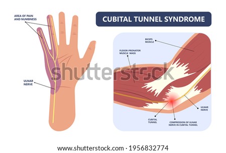 ulnar nerve muscle bone elbow swollen pain hand palm bone spurs ring little medial golfer radial arms wrist funny carpal tennis canal palsy test	