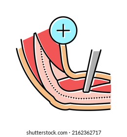 ulnar nerve release color icon vector. ulnar nerve release sign. isolated symbol illustration