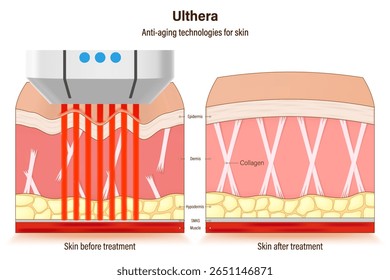 Tratamento com Ulthera. Tecnologias anti-envelhecimento para pele. procedimentos cosméticos médicos para pele. Comparar o estado da pele antes e depois do tratamento.
