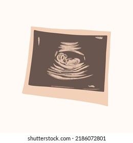 Ultrasound of a child in the womb, printed on paper. Vector illustration.