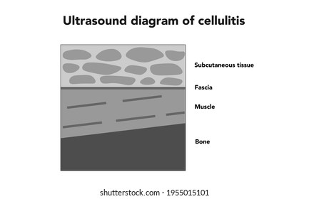 ultrasound diagram of cellulitis that showed tissue edema with cobblestones pattern