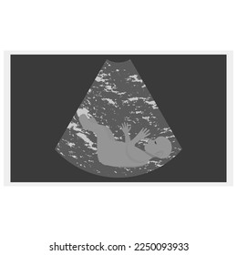 Ultrasound examination procedure. Pregnancy. The embryo in the ultrasound scan.