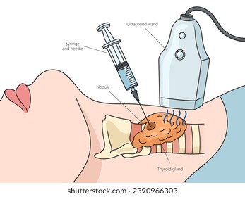 Diagrama de la estructura de punción de la biopsia tiroidea guiada por ultrasonido, ilustración esquemática del vector dibujada a mano. Ilustración de la ciencia médica