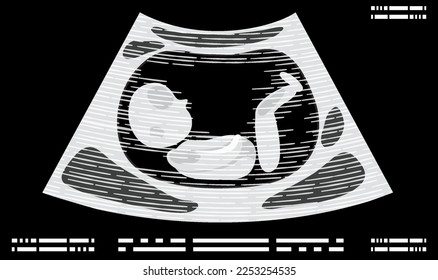 Ultrasound picture of fetus illustration