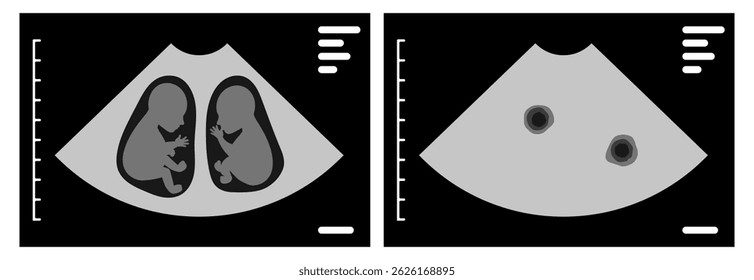 Ultrasound scan showing dichorionic diamniotic twins during pregnancy