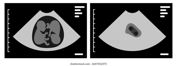 Ultrassom mostrando gêmeos monozigóticos interagindo dentro do útero, destacando a conexão profunda e o espaço compartilhado de gêmeos idênticos durante o desenvolvimento pré-natal