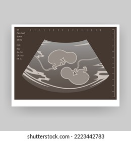  Ultrasound of a twin in the womb. Vector illustration in grayscale. An ultrasound image of a baby. Medicine and health of the fetus of twins. Realistic Embryo Sonogram