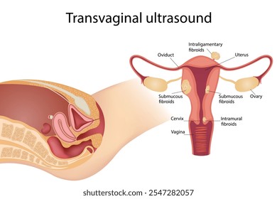 Ultrassom de exame vaginal Diagnóstico de problemas de fertilidade células menstruais pólipo cervical