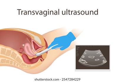 Ultrassom de exame vaginal Diagnóstico de problemas de fertilidade células menstruais pólipo cervical