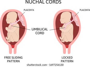 Cuerpo Umbilical alrededor del Cuello. dos tipos de cordón Nuchal. deslizamiento libre, que puede deshacer por sí mismo, y el patrón bloqueado rodea el cuello. Ilustración vectorial médica aislada en blanco.